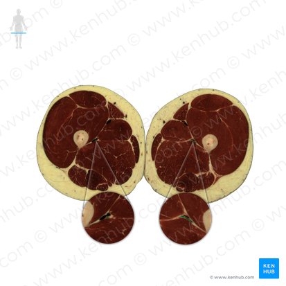 Arteria profunda femoris (Tiefe Oberschenkelarterie); Bild: National Library of Medicine