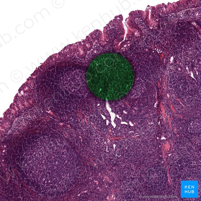 Tecido linfoide difuso; Imagem: 