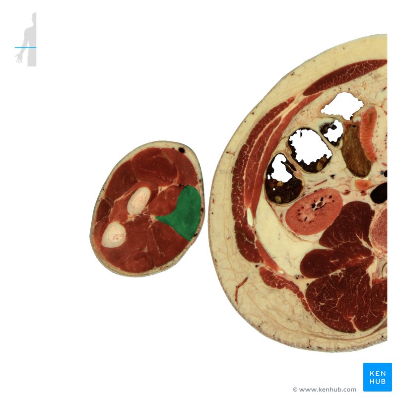 Flexor carpi radialis muscle - cross-sectional view