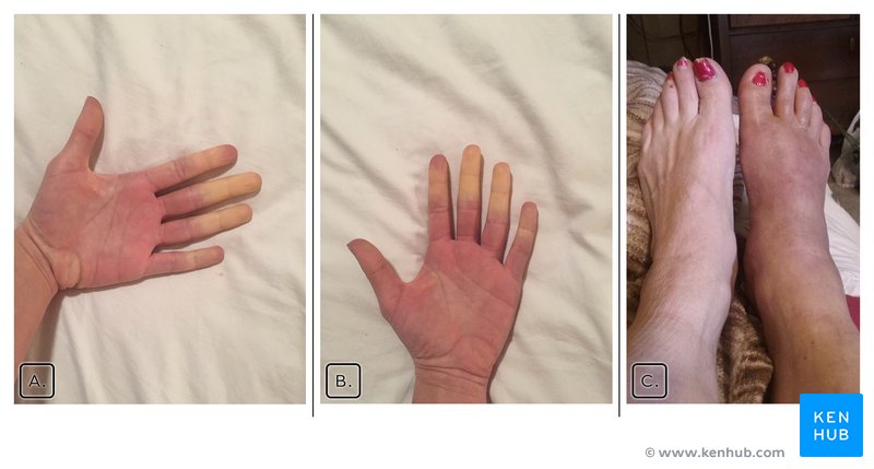 Primary Raynaud’s Phenomenon