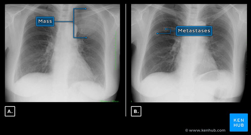 Anterior chest wall tumor - radiography