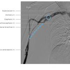 Clinical case: Pectoralis minor syndrome