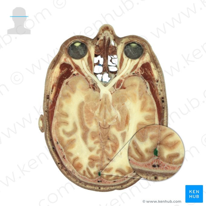 Sinus sagittalis superior (Oberer Pfeilblutleiter); Bild: National Library of Medicine