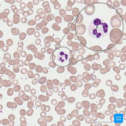 Chromatinum sexuale neutrophili (Geschlechtschromatin des Neutrophilen Granulozyten); Bild: 