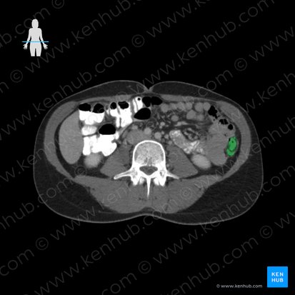 Descending colon (Colon descendens); Image: 