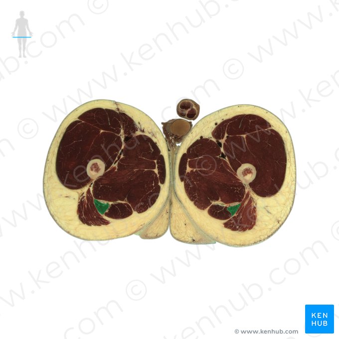 Cabeça longa do músculo bíceps femoral (Caput longum musculi bicipitis femoris); Imagem: National Library of Medicine