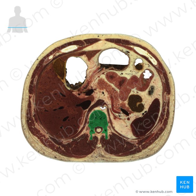 Vértebra T12 (Vertebra T12); Imagem: National Library of Medicine