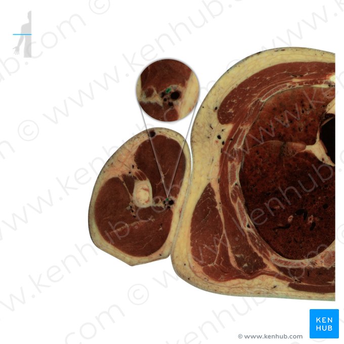 Artéria braquial (Arteria brachialis); Imagem: National Library of Medicine