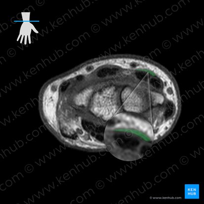 Tendon of extensor pollicis longus muscle (Tendo musculi extensoris pollicis longi); Image: 