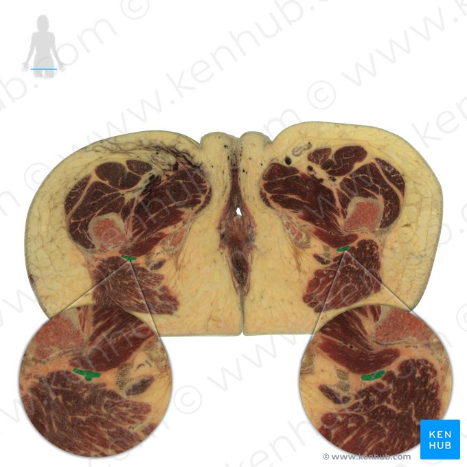 Sciatic nerve (Nervus ischiadicus); Image: National Library of Medicine