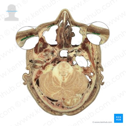 Músculo elevador del labio superior (Musculus levator labii superioris); Imagen: National Library of Medicine