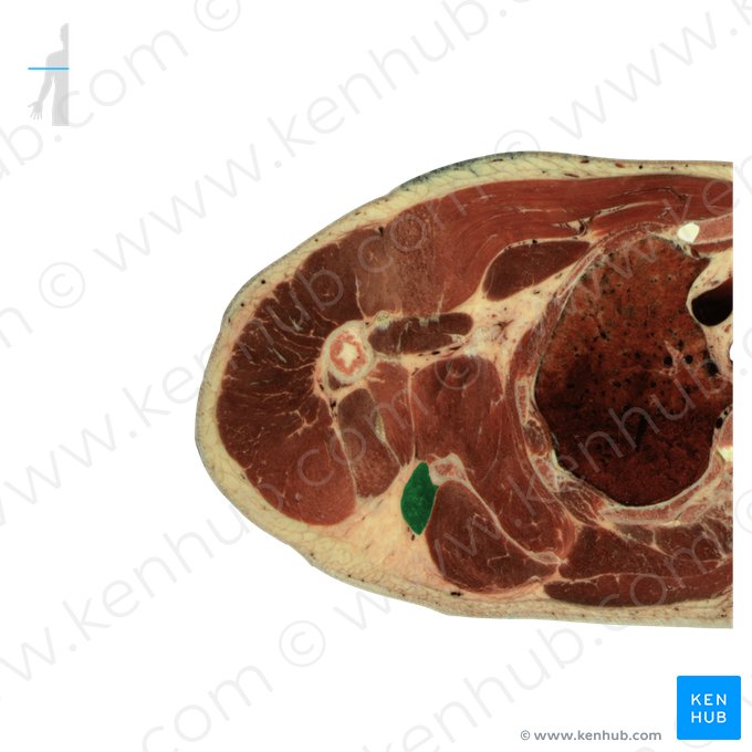 Músculo redondo menor (Musculus teres minor); Imagem: National Library of Medicine