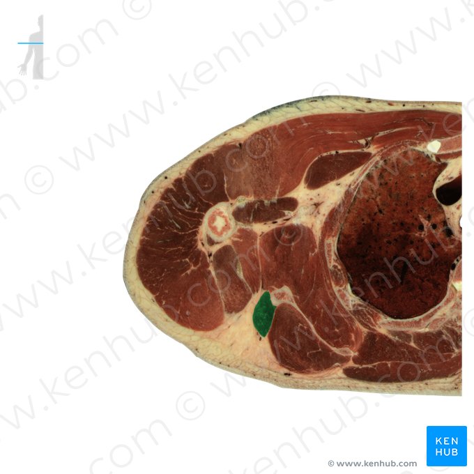 Teres minor muscle (Musculus teres minor); Image: National Library of Medicine