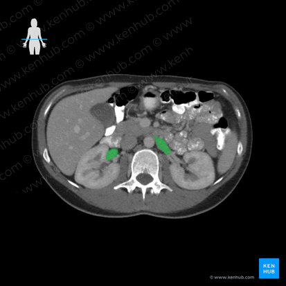 Renal vein (Vena renalis); Image: 