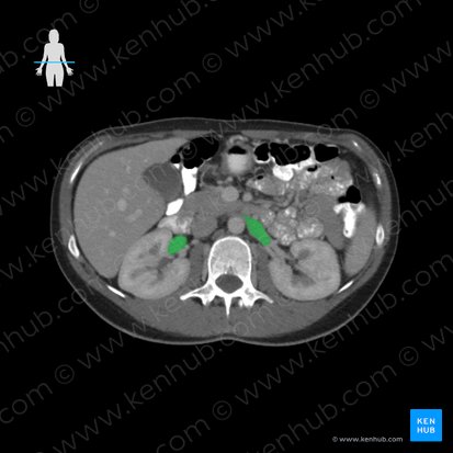 Renal vein (Vena renalis); Image: 