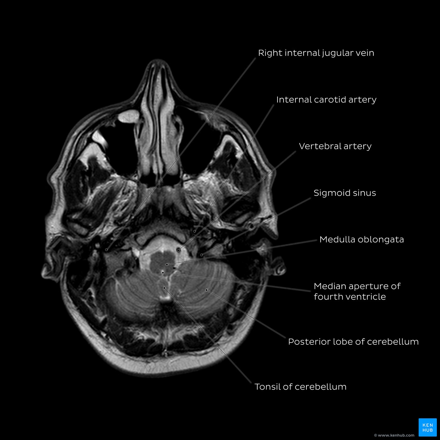 Brain MRI (cerebellum level)