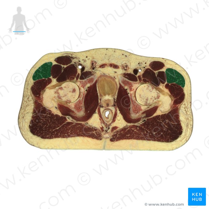 Músculo tensor da fáscia lata (Musculus tensor fasciae latae); Imagem: National Library of Medicine