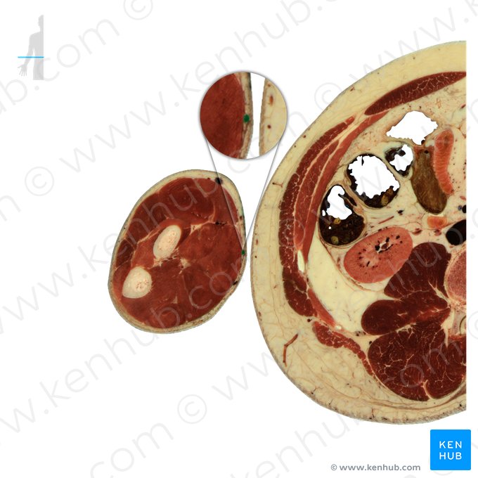 Veia cubital mediana (Vena mediana cubiti); Imagem: National Library of Medicine