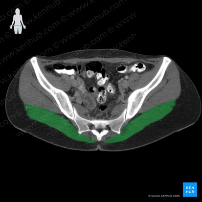 Musculus gluteus maximus (Großer Gesäßmuskel); Bild: 