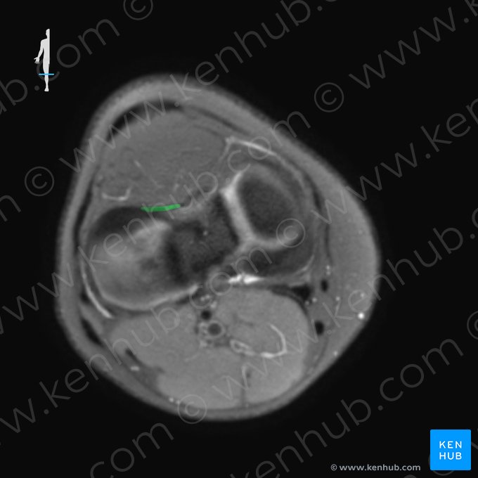 Ligamento transverso do joelho (Ligamentum transversum genus); Imagem: 