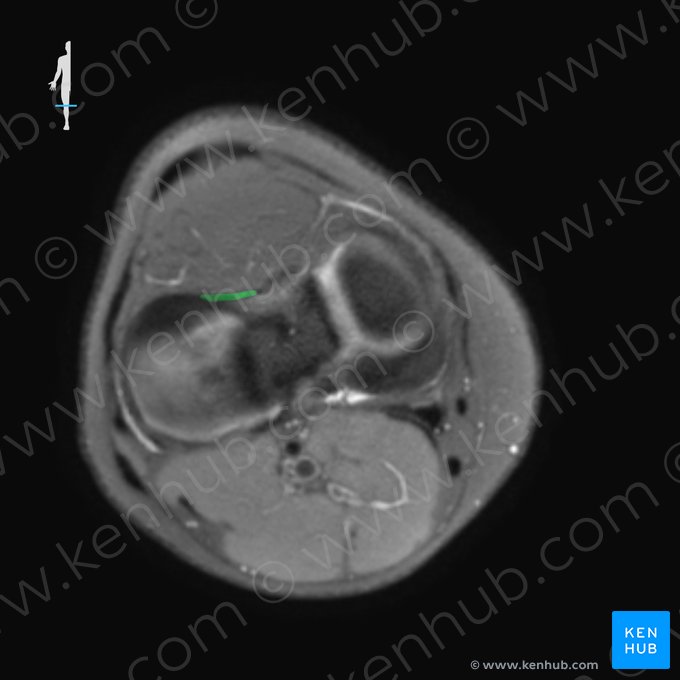 Ligamentum transversum genus (Queres Knieband); Bild: 