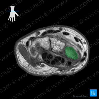 Scaphoid bone (Os scaphoideum); Image: 