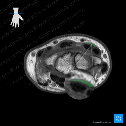 Tendon of extensor pollicis longus muscle (Tendo musculi extensoris pollicis longi); Image: 