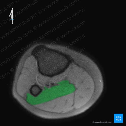 Musculus soleus (Schollenmuskel); Bild: 