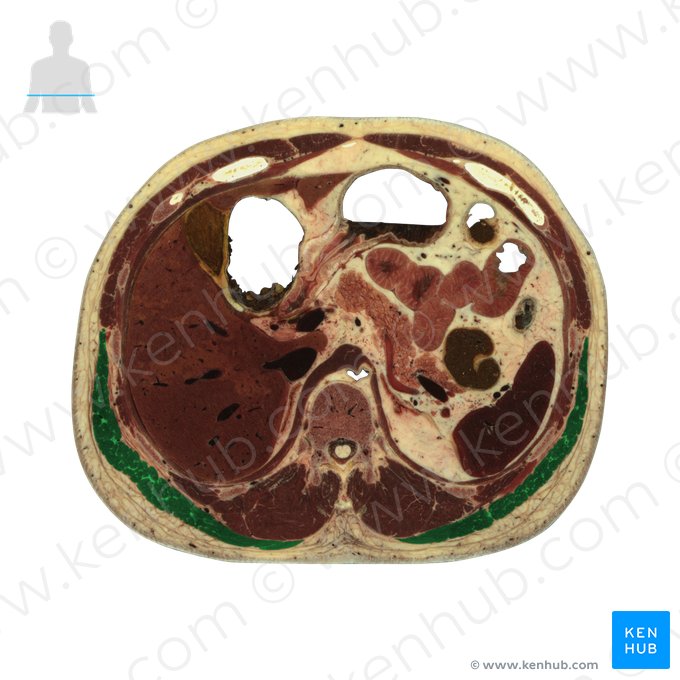 Músculo latíssimo do dorso (Musculus latissimus dorsi); Imagem: National Library of Medicine