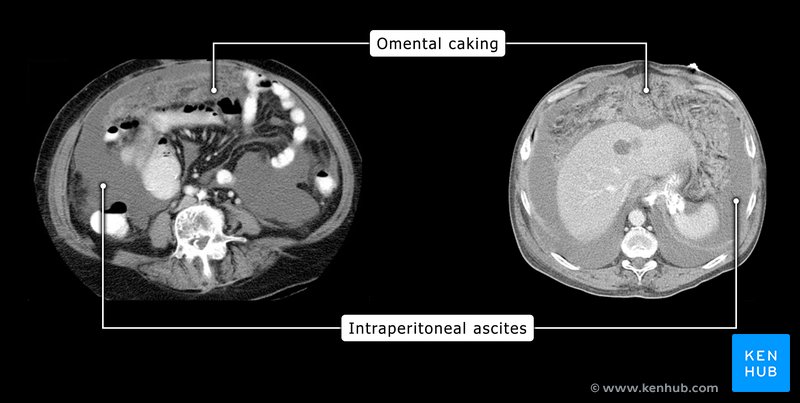 Omental caking and intraperitoneal ascites - coronal CT