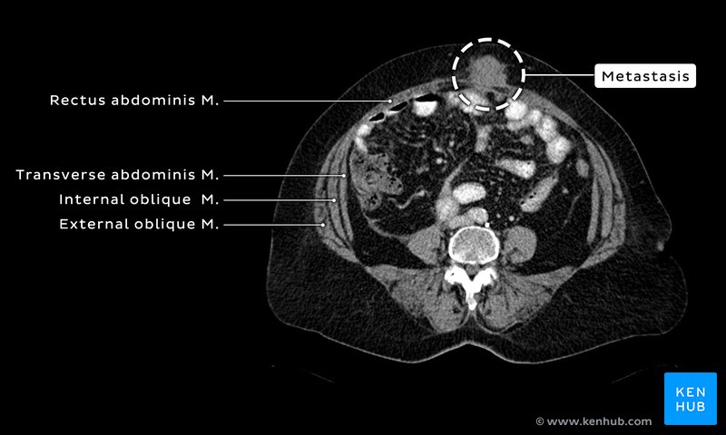 Metastatic tumor in the umbilicus