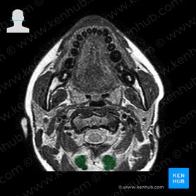 Musculus rectus capitis posterior major (Großer hinterer gerader Kopfmuskel); Bild: 