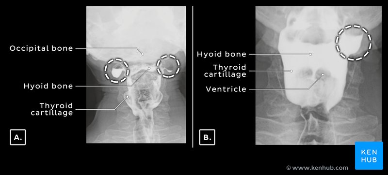 Pharyngeal diverticuli - barium swallow exam