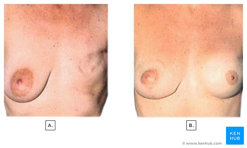 Breast Reconstruction