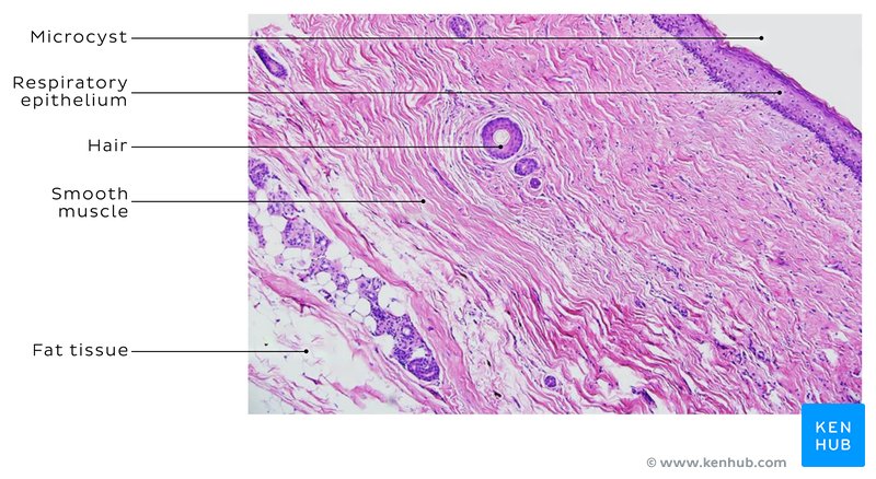 Dermoid cyst