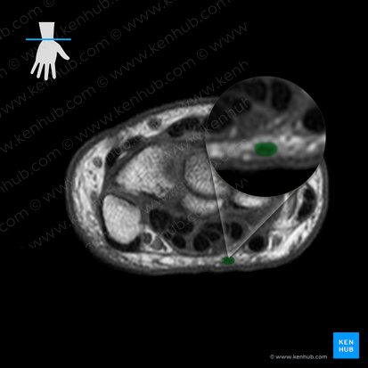 Tendão do músculo palmar longo (Tendo musculi palmaris longus); Imagem: 