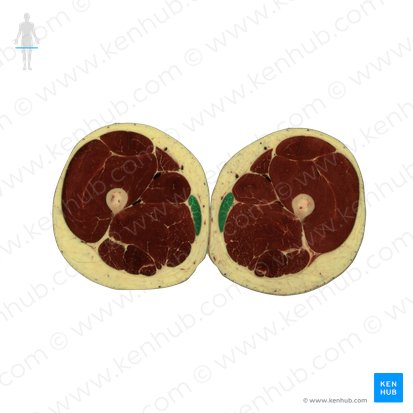 Músculo grácil (Musculus gracilis); Imagen: National Library of Medicine