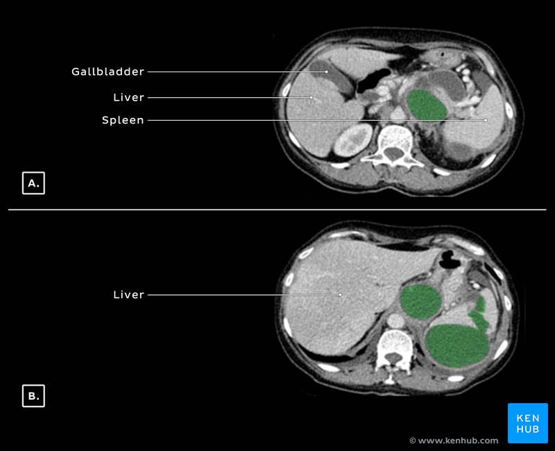 Pancreatic and splenic pseudocysts