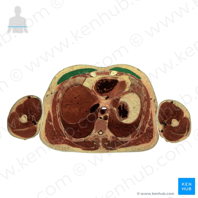 Pectoralis major muscle (Musculus pectoralis major); Image: National Library of Medicine