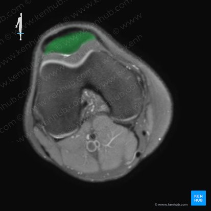 Patella (Kniescheibe); Bild: 