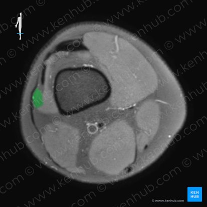 Vastus lateralis muscle (Musculus vastus lateralis); Image: 