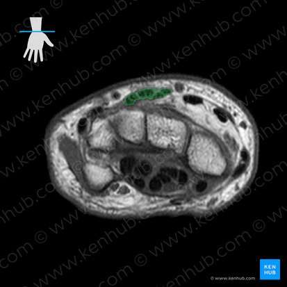 Tendons of extensor digitorum and extensor indicis muscles (Tendines musculi digitorum et musculi extensoris indicis); Image: 