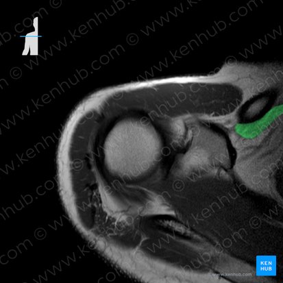 Musculus subclavius (Unterschlüsselbeinmuskel); Bild: 