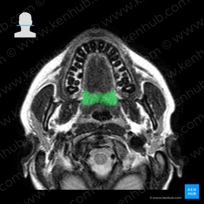 Palatine tonsil (Tonsilla palatina); Image: 