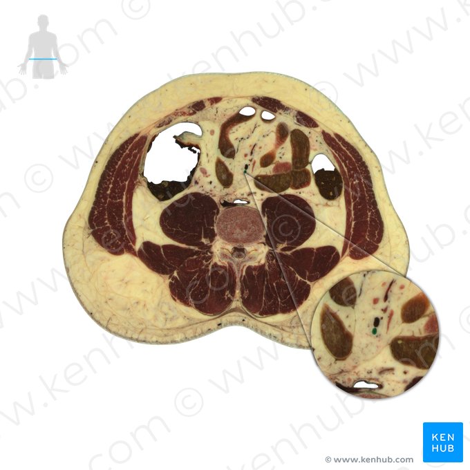 Vena mesenterica superior (Obere Eingeweidevene); Bild: National Library of Medicine