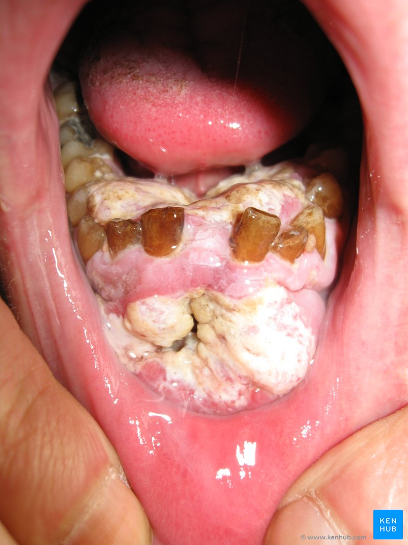 Oral cancer in a smoker