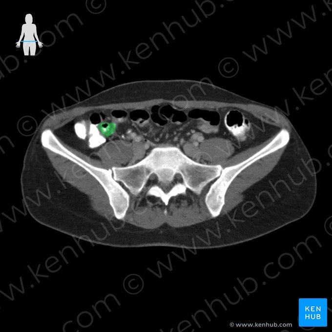 Papila ileal (Papilla ilealis); Imagen: 