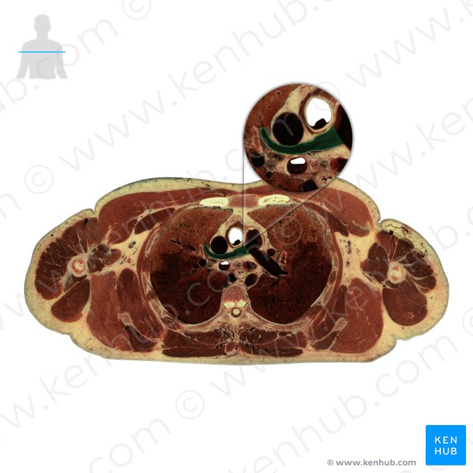 Right pulmonary artery (Arteria pulmonalis dextra); Image: National Library of Medicine