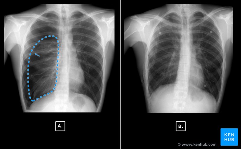 Chest X-ray - pneumothorax