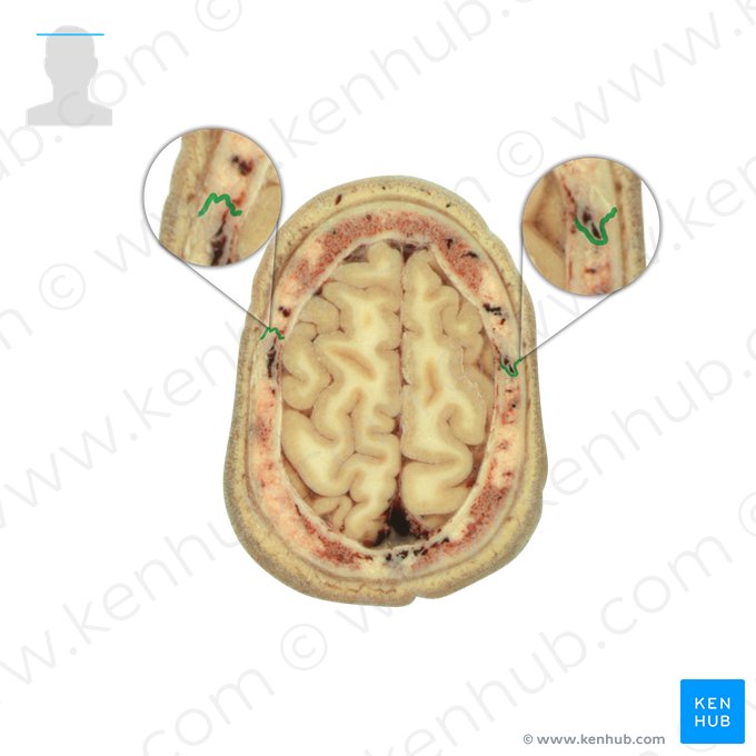 Coronal suture (Sutura coronalis); Image: National Library of Medicine